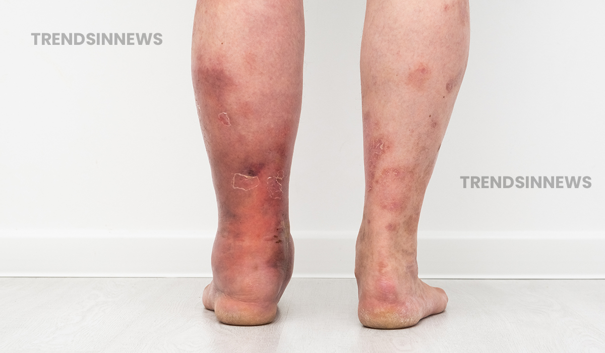 Swelling in Legs; Symptoms, Causes, and Treatment