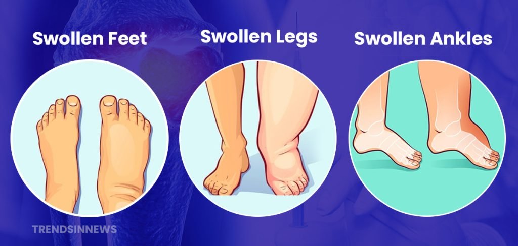 Symptoms of swelling legs 