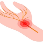 Kubital Tünel Sendromu ve Karpal Tünel Arasındaki Fark Nedir? Hangi Belirtiler Ayırıcıdır?