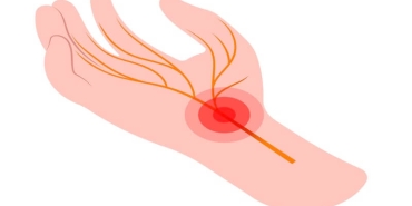 Kubital Tünel Sendromu ve Karpal Tünel Arasındaki Fark Nedir? Hangi Belirtiler Ayırıcıdır?