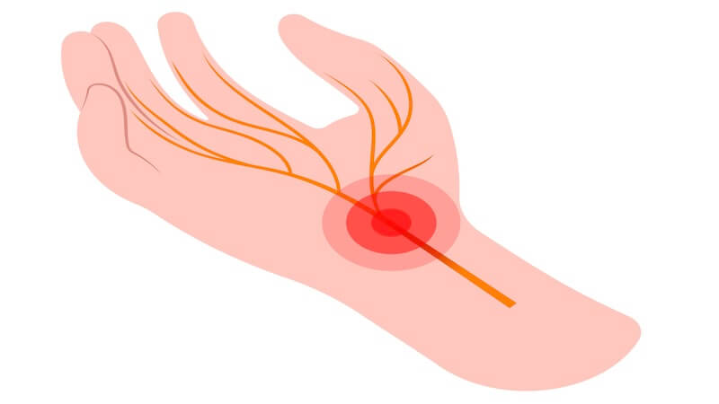 Kubital Tünel Sendromu ve Karpal Tünel Arasındaki Fark Nedir? Hangi Belirtiler Ayırıcıdır?